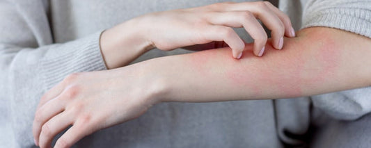 How Linen Helps Prevent Skin Allergies Caused by Synthetic Fabrics